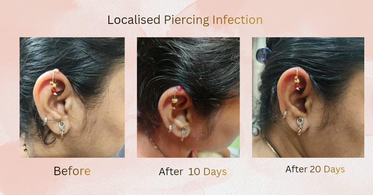 Localized Piercing Infection
