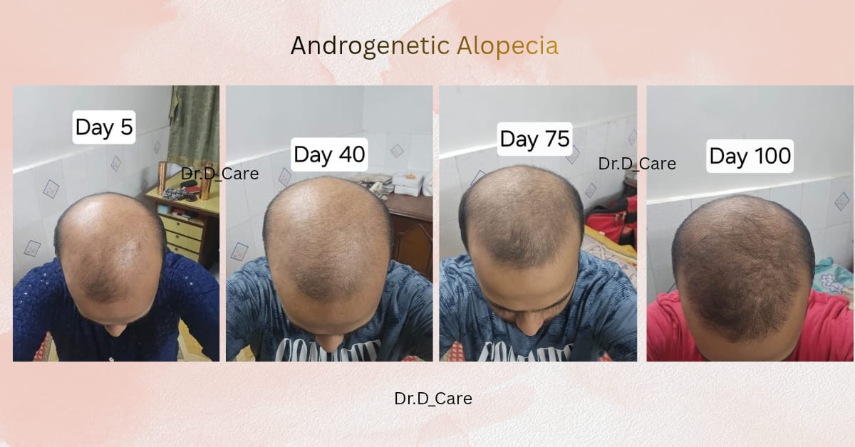 Androgenetic Alopecia