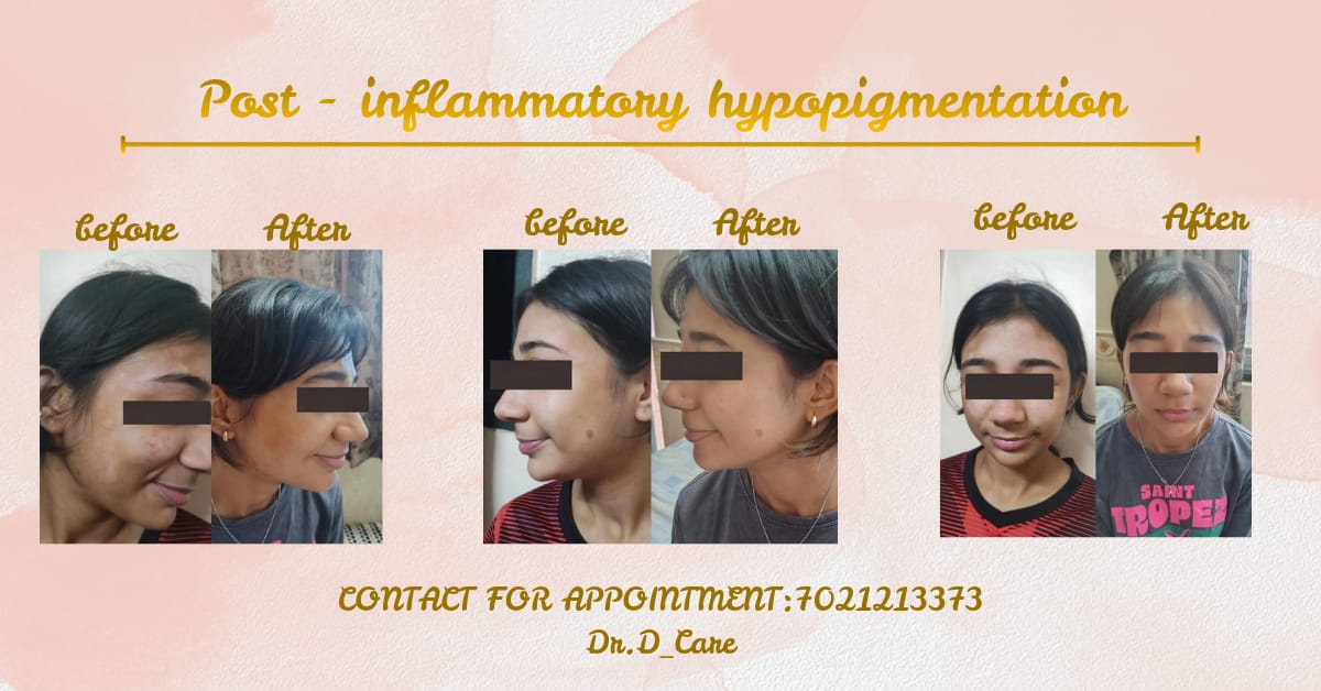 Post Inflammatory Hypopigmentation